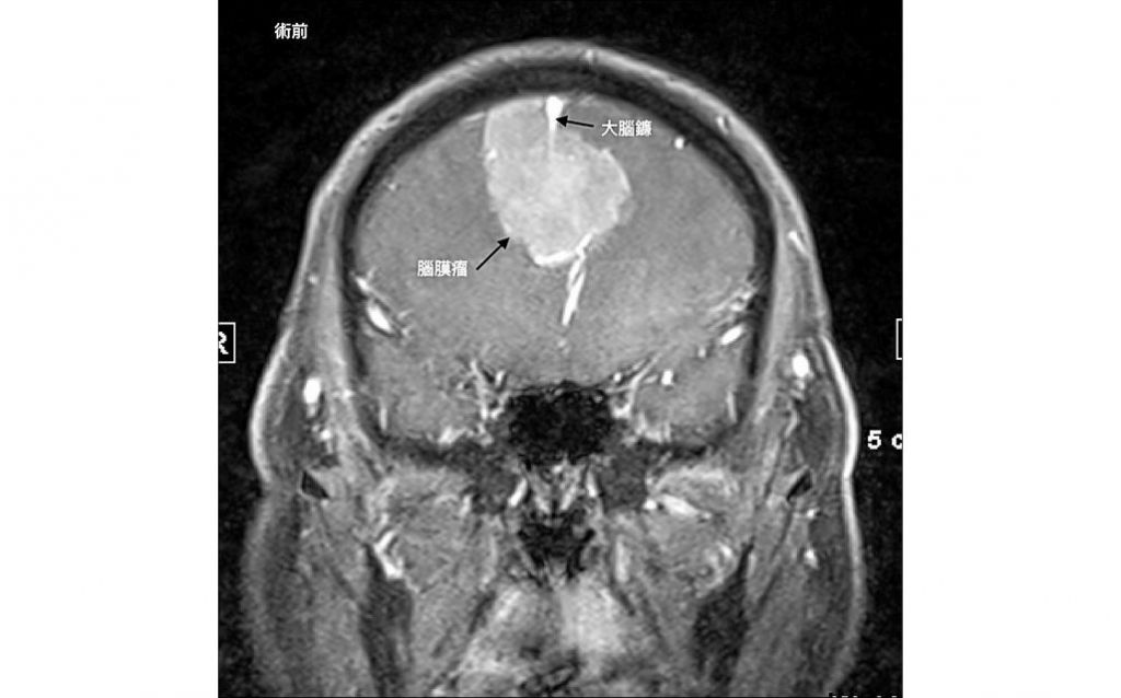 神秘微笑非中邪 6cm「大腦鐮腫瘤」作祟