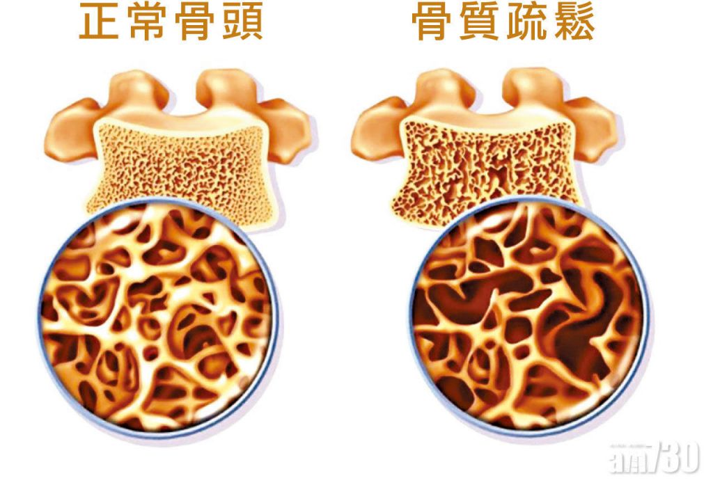 類風濕性關節炎破壞關節 嚴重或須輪椅代步